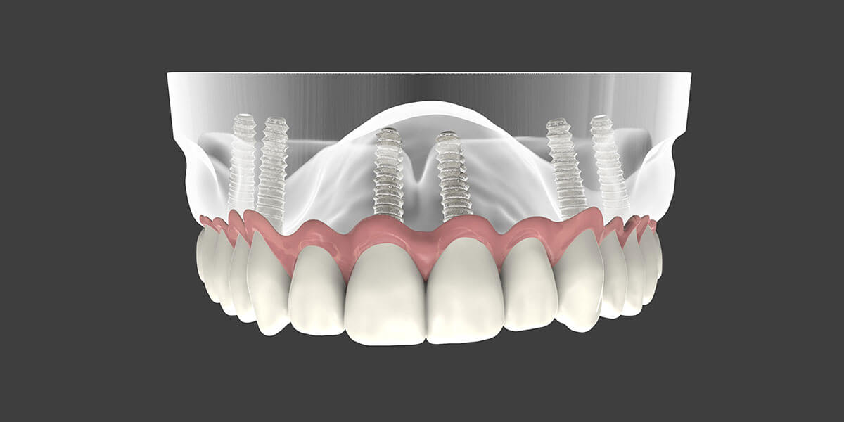 Implant Supported Dentures - Patient Smile