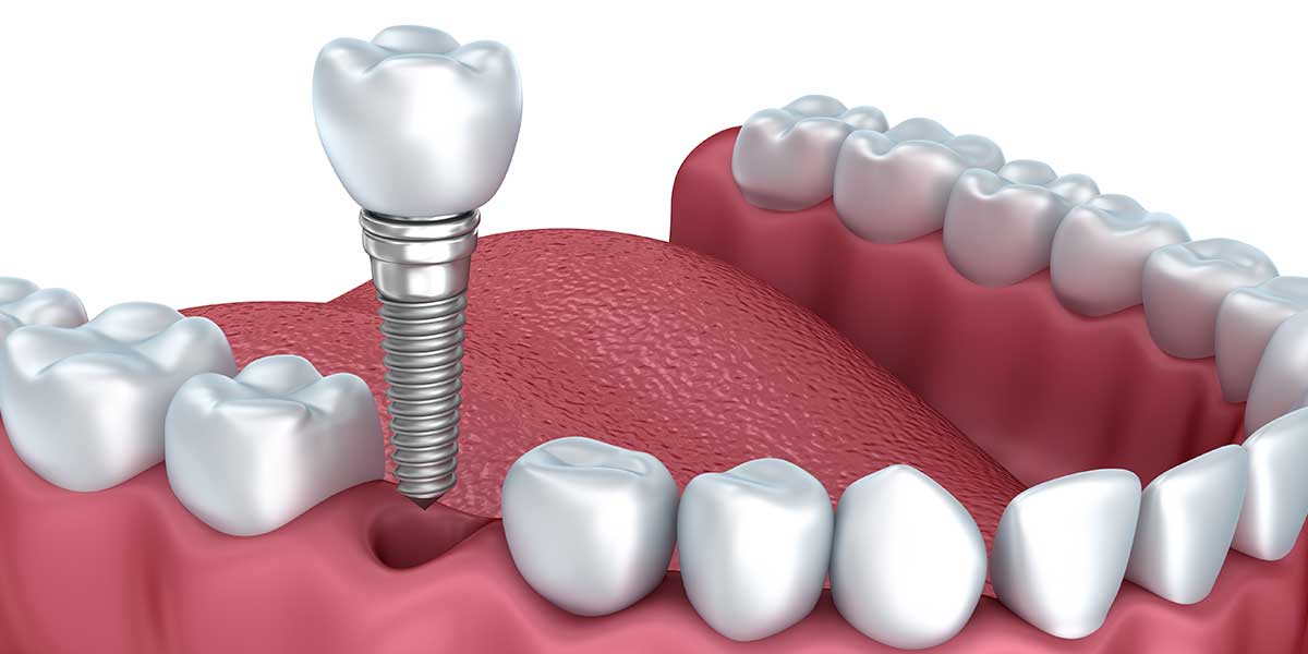 Implants Graphic Illustration