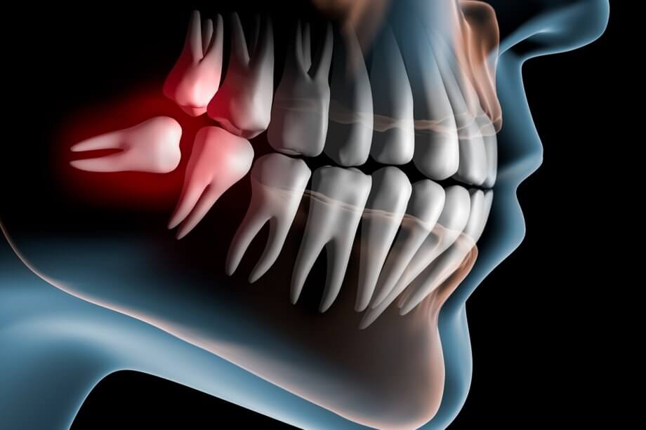 Does Removing Wisdom Teeth Change Your Facial Appearance?