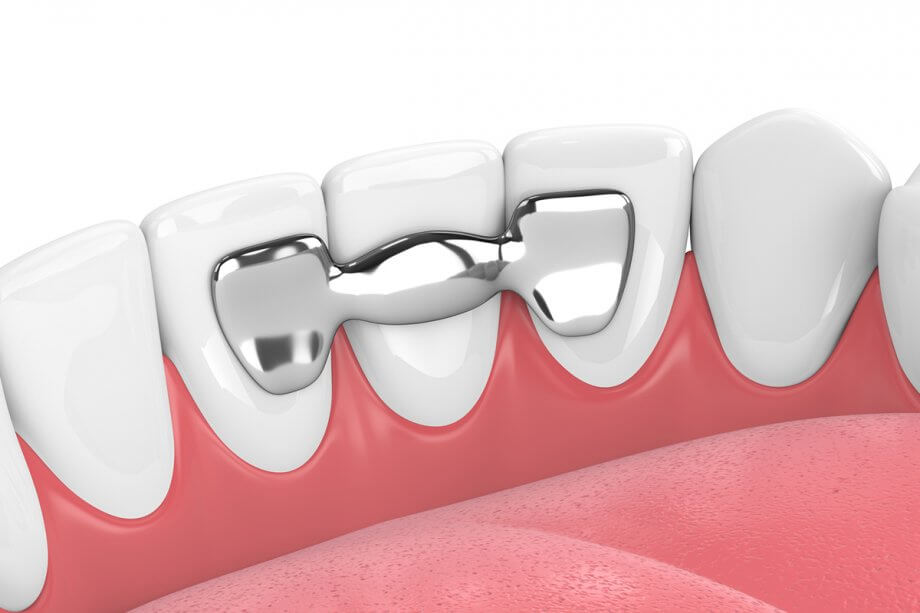 How Do You Clean & Floss a Dental Bridge?