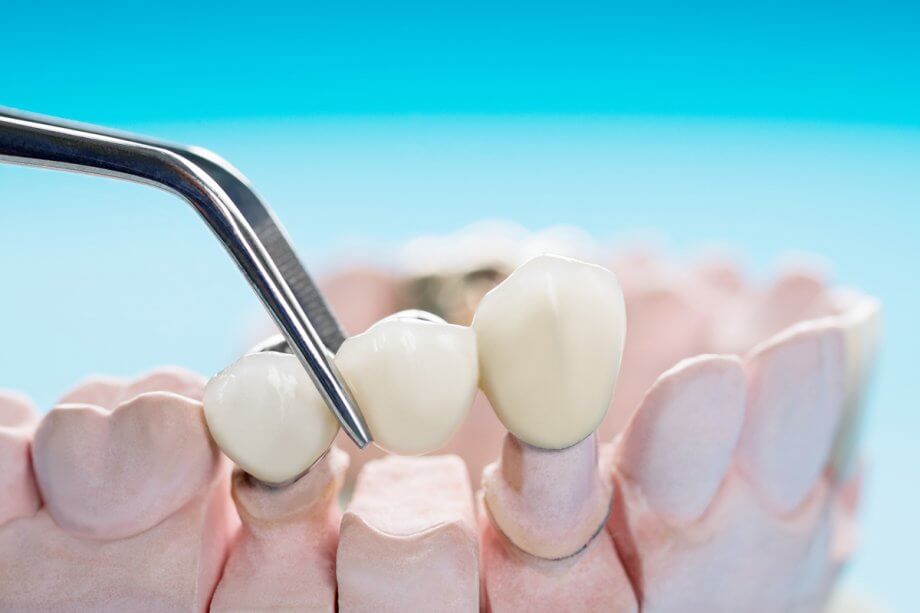 How Much Does A Dental Bridge Cost in Middlesex County?